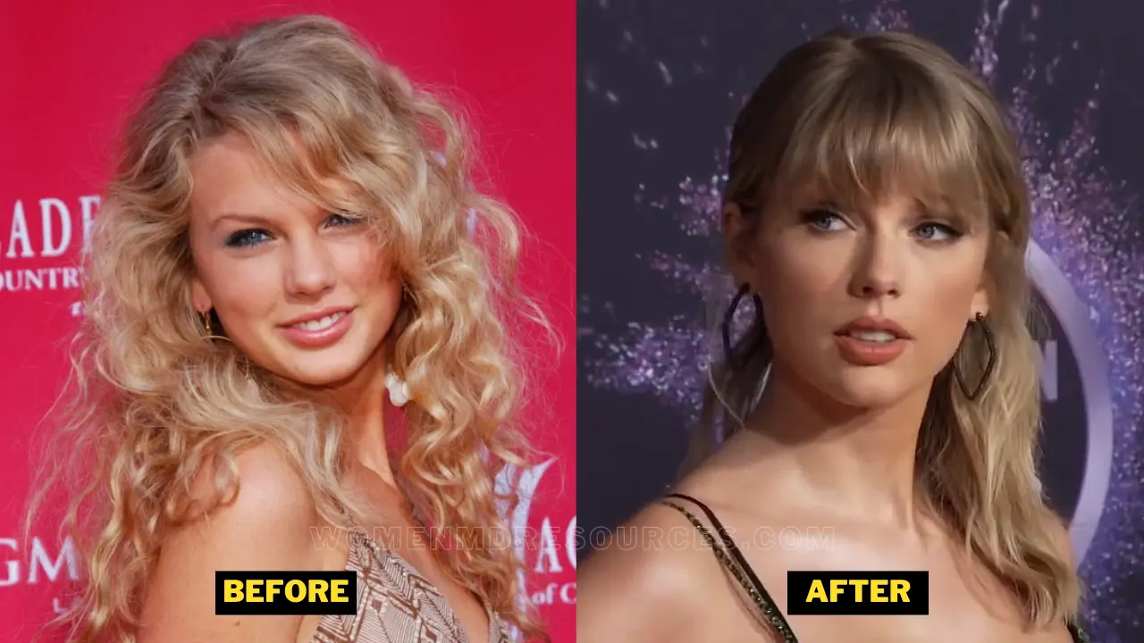 Taylor Swift Before And After Plastic Surgery 03 Cele